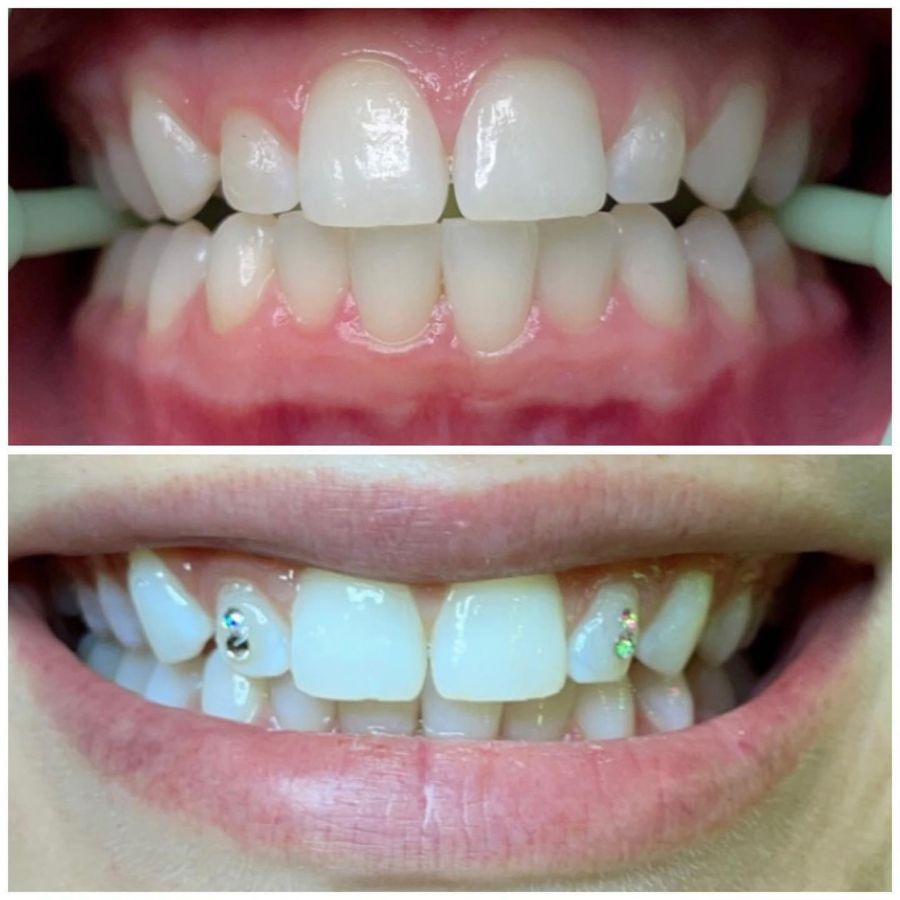 Teeth Whitening and Tooth Gems Results