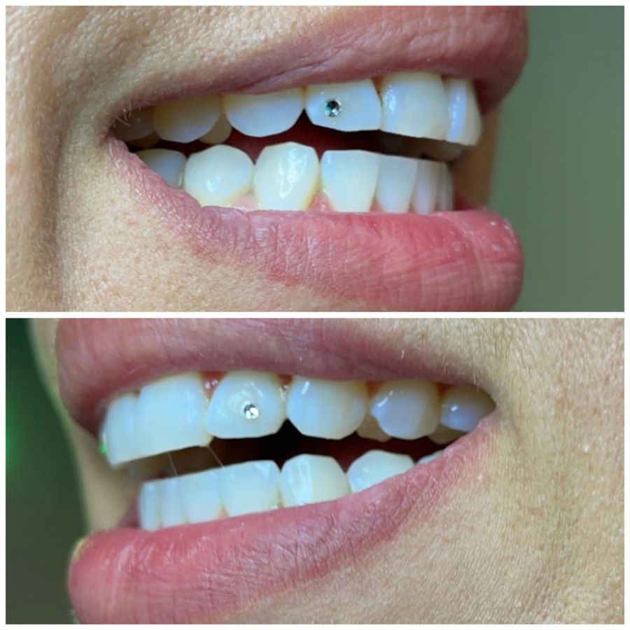 Tooth Gems Results