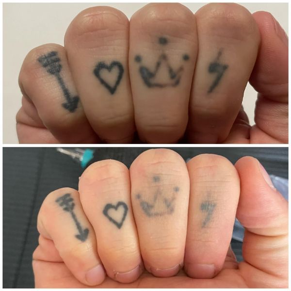 Tattoo Removal Results