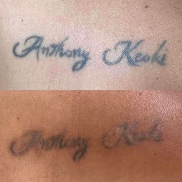 Tattoo Removal Results