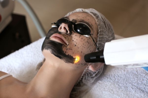 Carbon Laser Facial services