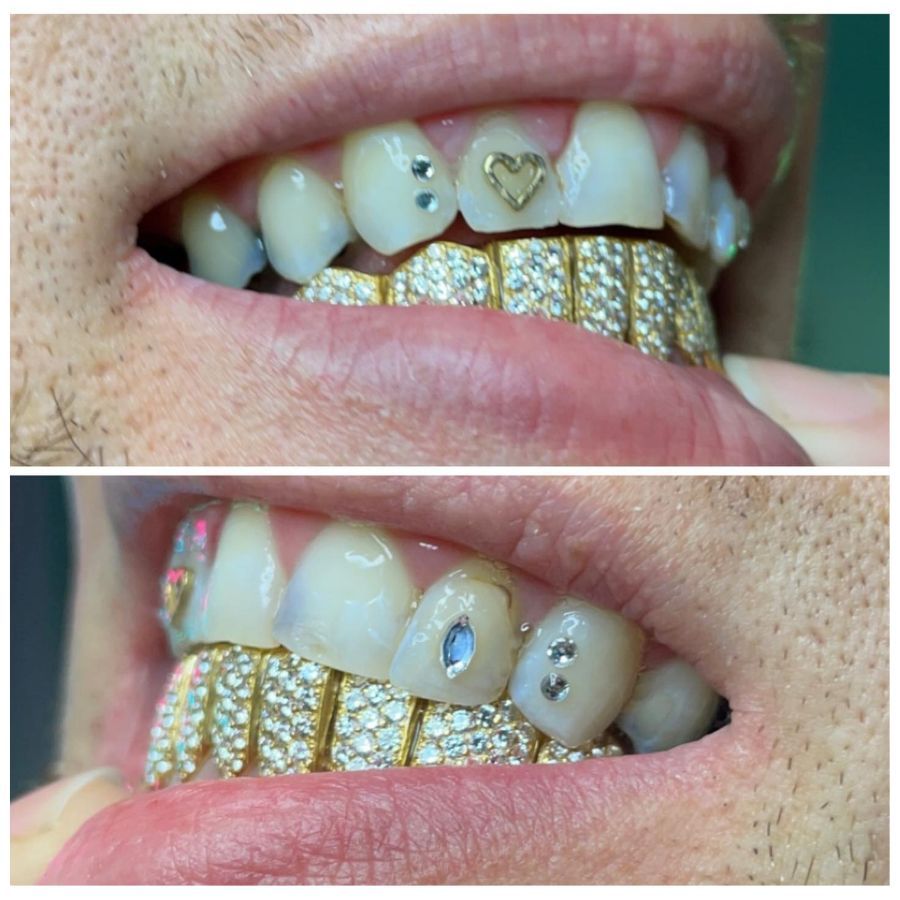 Tooth Gems Results