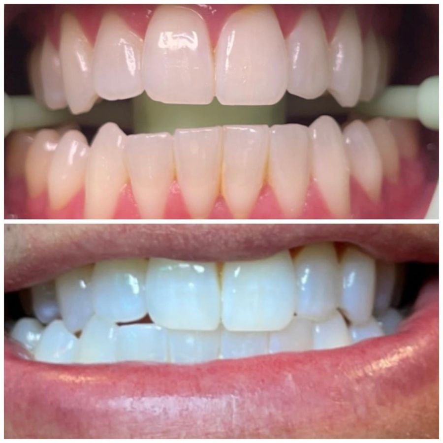 Before and After Teeth Whitening