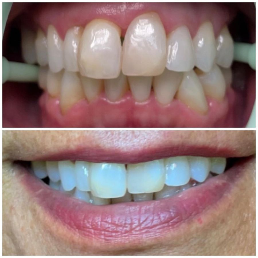 Before and After Teeth Whitening