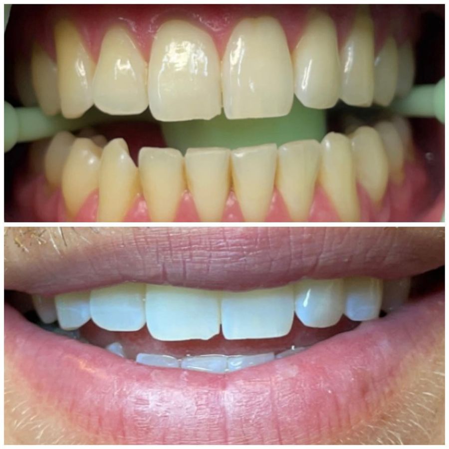 Before and After Teeth Whitening