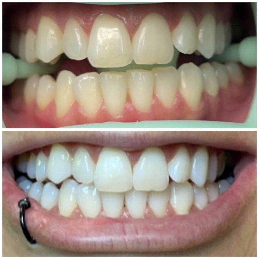 Before and After Teeth Whitening