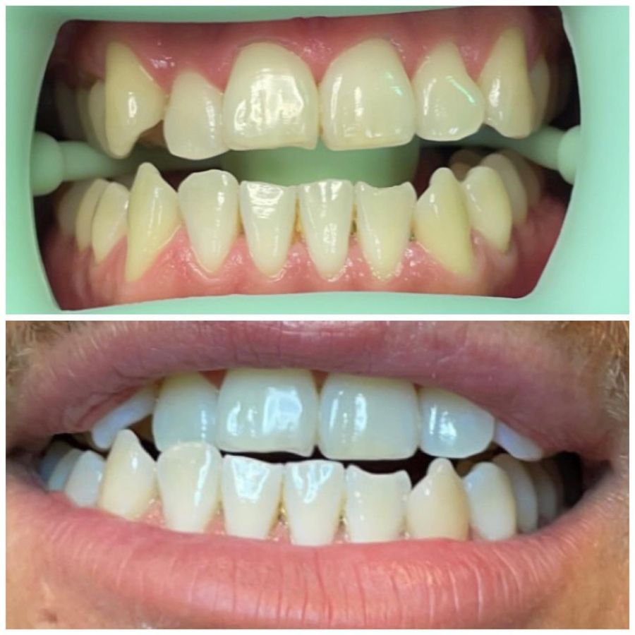 Before and After Teeth Whitening