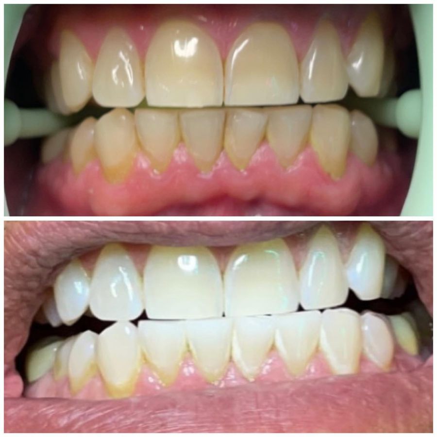 Before and After Teeth Whitening