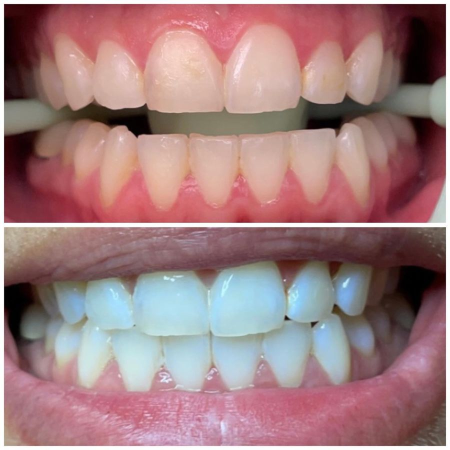 Before and After Teeth Whitening